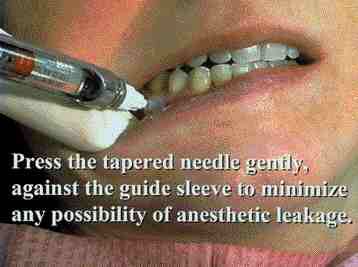 Dentsply Maillefer X-Tip Intraosseous Anesthetic Delivery System – Dental Endodontic Tool