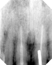 FIGURE 11--Twelve month follow-up on tooth 8 demonstrating resorption of excess sealer apically.