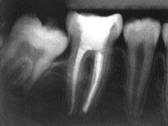 FIGURE 5--Radiograph taken after completion of endodontic treatment, July 2002.