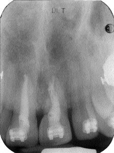 Final endo x-ray.