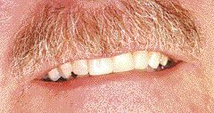 FIGURE 11--Buccal view of the smile ten years after the partial denture was placed.