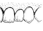 FIGURE 37--Ovate pontic appears to be naturally emerging from ridge.