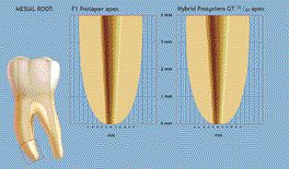 FIGURE 14--The apical control zone created by the Protaper files and augmented by the ProSystem GT files is demonstrated. The enhanced deep shape effect of the Hybrid Approach is readily apparent. The cutting efficiency of the Protaper files exceeds that of the ProSystem GT files, however the resultant shaping produced by the ProSystem GT files with their array of variable tapers results in the creation of a more substantial apical control zone enabling greater density in the apical region and thus preventing inadvertent overfills and overextensions.