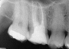 FIGURE 27--Immediate postoperative radiograph. Mb and Mb2 join in the coronal third to exit as one canal.