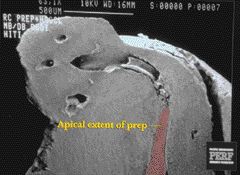 FIGURE 1--Significant uncleaned and unfilled space remains after root canal filling in the various apical delta canals. Even though the root canal radiographically might appear approx. 2mm short, it is in reality much shorter given the untreated canal anatomy.