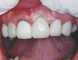 FIGURE 22--Final crown two months after cementation.