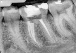 FIGURE 3C--Post-operative radiograph displaying convergence of middle mesial and mesiolingual canals.