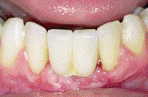 CASE 2FIGURE 23--The crown(s) cemented on the abutment.