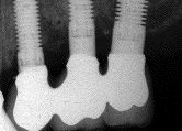 FIGURE 9--A periapical x-ray demonstrating 4mm diameter implants in the premolar region and a 5mm diameter implant in the molar position.