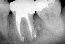 FIGURE 5--Periapical radiograph demonstrating osseous healing.