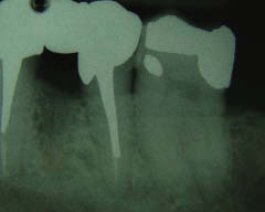 Figure 4-The final restoration at recall radiograph showing adaption of restoration and excellent bone height in the area of root removal.