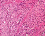 Figure 3--Histopathology of WHO grade 1 meningioma showing a very vascular tumor with cells which have spindle shaped morphology,elongated hyperchromatic nuclei and infiltrates of fibrocollagenous and skeletal muscle tissue. (H&E, 100x).