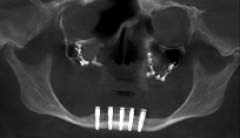 Figures 12 a-b-c and d-This sequence shows the bone vertical augmentation that has been attained.