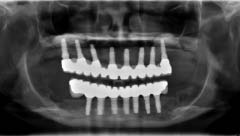 Figures 13 a, b-A panoramic radiograph of the final restorations, implants and bone grafts.