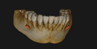 Figure 1-Extended field of view (3D volume stitching program) with alveolar nerve mapped. Kodak 9000 3D extraoral imaging system