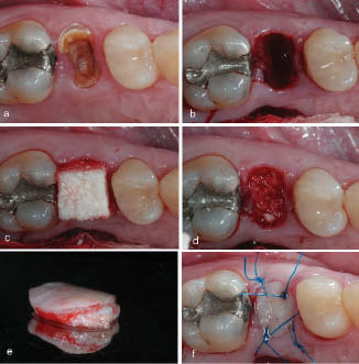 Figure 6-Clinical photographs illustrating a graft procedure following tooth extraction. The root fragment in the alveolar socket (a). Entrance of the alveolar socket after flapless extraction (b). Biomaterial. Note that the biomaterial should be trimmed as needed (c). The biomaterial packed into the socket to the level of the bone margin (d). Free gingival graft removed from the palate (e). The entrance of the socket is closed by the gingival graft that is secured in place by single sutures (f).