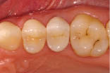 Figure 12. Postoperative occlusal view of the IPS e.max CAD crown after cementation with a self-adhesive luting composite.