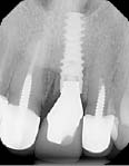 Figure 16 - Final treatment smile.