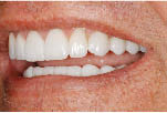 Figure 4C - Lateral smile completed treatment.