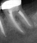 Figure 21 - Recall (1-year) radiograph showing complete healing