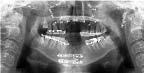 Figure 5 - Post operative panorex showing anterior tooth loss with extensive alveolar bone loss making prosthetic reconstruction a challenge.