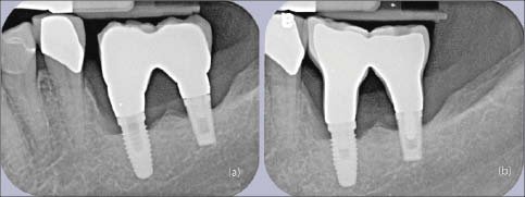 Figure 16. (a) This cemented two-unit fixed prosthesis (splinted crowns) 36-37 was clinically mobile. A slight gap is present between the abutments and the implant platforms especially at the implant 37. Note the "absence" of the abutment screw within the implant 36. This observation is important because it implies that this fixed prosthesis may be removed by accessing the distal abutment screw only. This cemented prosthesis had to be cut off and a new screw-retained fixed prosthesis was fabricated as part of an overall treatment plan. (b) The new two-unit screw-retained fixed prosthesis. Note the presence of both abutment screws as well as the depth of their positions within the implants (screw chambers). In particular, note that depth of abutment screw position within the implant screw chamber of implant 37 between the old loose prosthesis (a) and the new one (b).