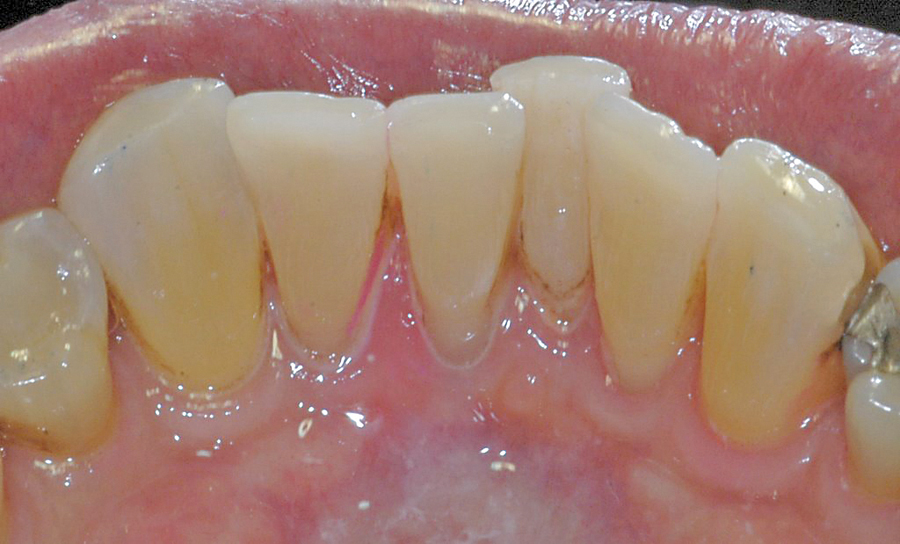 Figure 39. Typical sextant of incisal and inciso-lingual restorations, 5 years post-op. 37% Liquid Phosphoric acid etch 15 seconds, Danville Microprime B, Kuraray Photobond, Tokuyama Estelite Sigma A3.