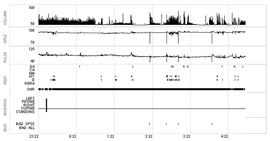 Figure (b). At right is a three-month follow-up recorded while wearing the Moses appliance. Note the significant drop in snoring volume (labeled Volume), dramatic improvement in the saturation of peripheral oxygen (SpO2), substantially less ANS arousals shown in Pulse rate, and vast improvement in apnea-hyopnea index (Resp). The apnea-hypopnea index at baseline was 72.1 but plummeted to 5.7 when wearing the appliance.