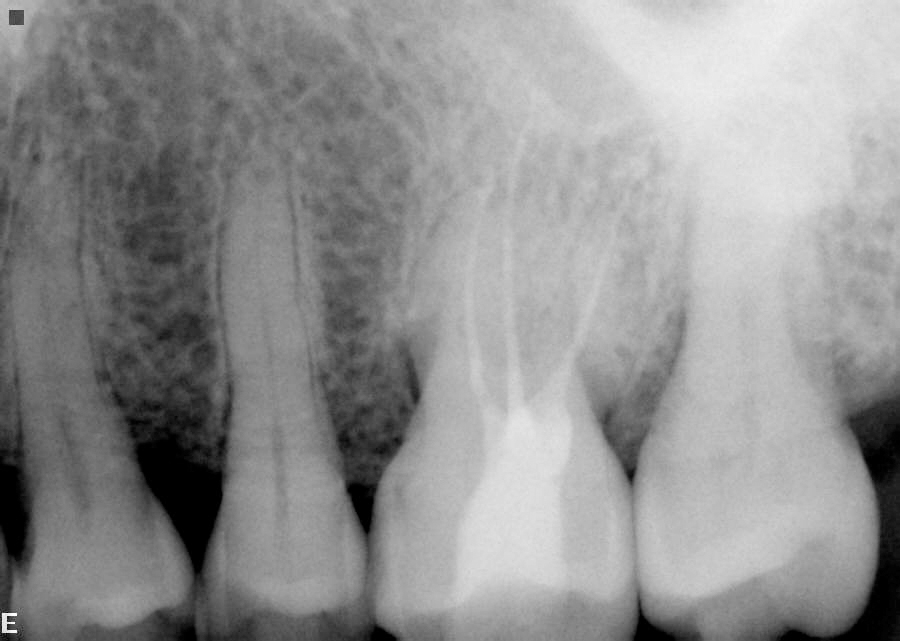 Figure 12. Final radiograph of obturated case.