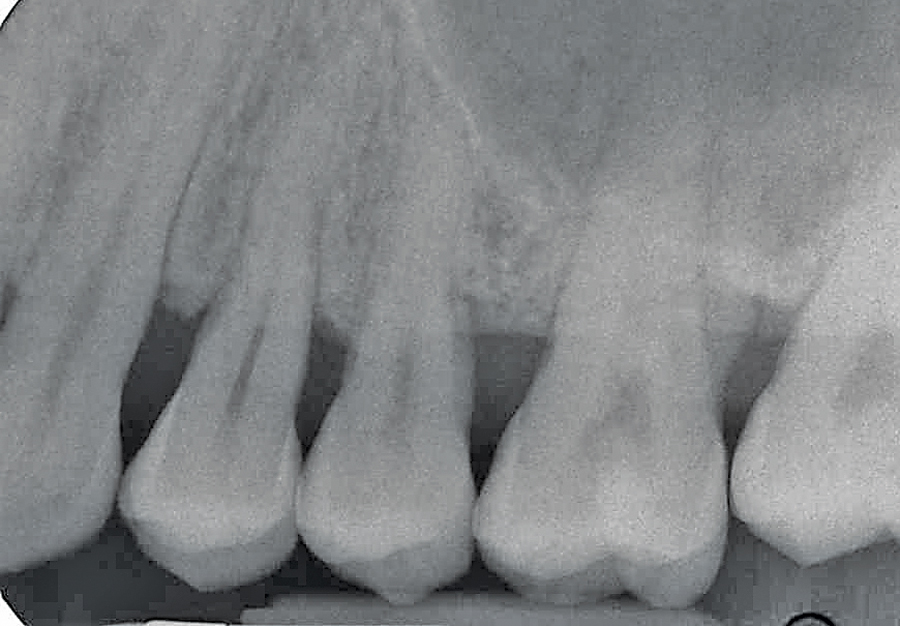 Figure 9D. Two year radiographic follow up hard tissue response.