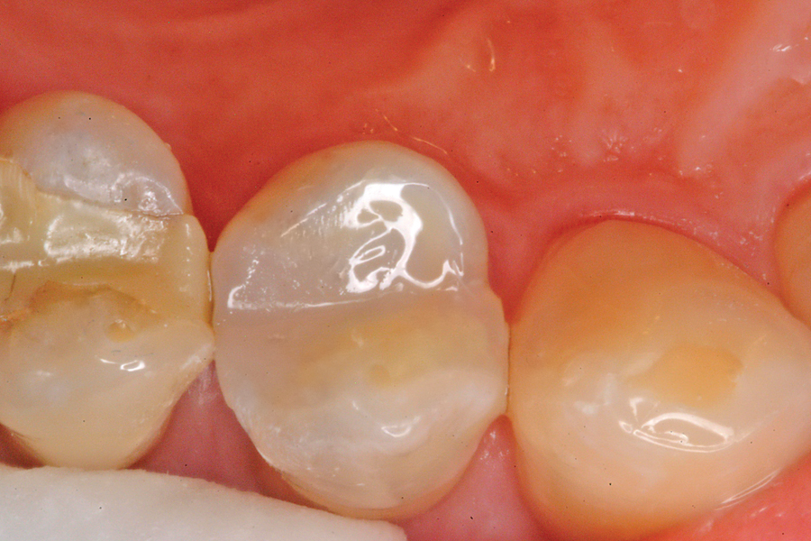 Figure 11. The completed Perimeter Restoration will now serve the patient effectively for many years.