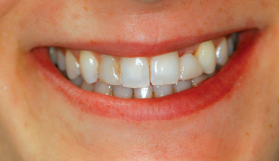 Figure 27. Final post-cementation smile.