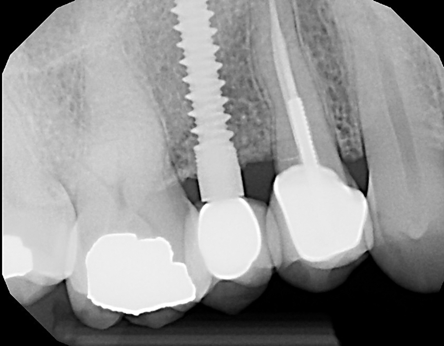 Figure 7. After 2 years, bone growth & increased bone density.