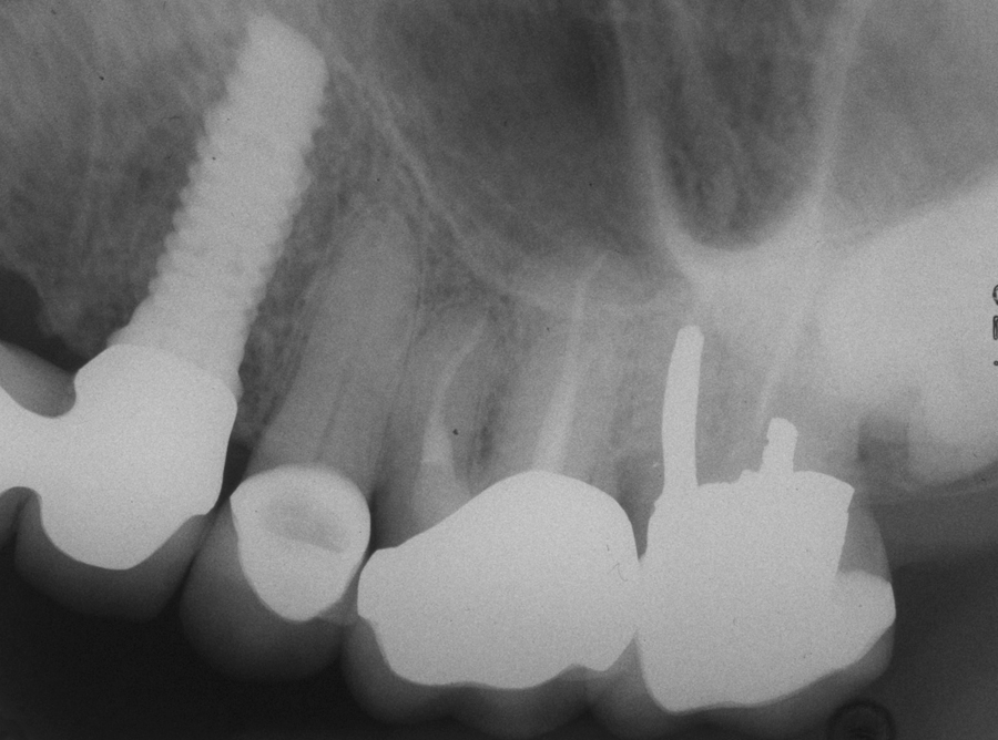 Figure 16. Final radiograph of bridge #11-24, showing #24 abutment.