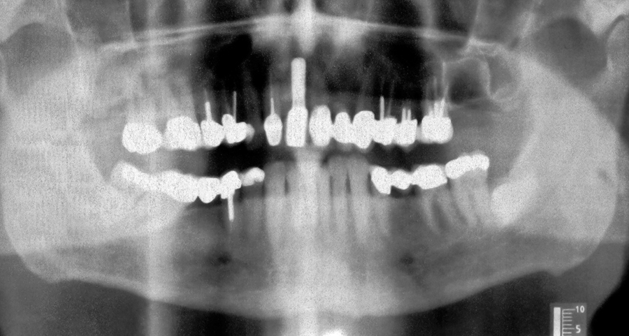 Figure 22. Panoramic of final implant supported crown at site #11.