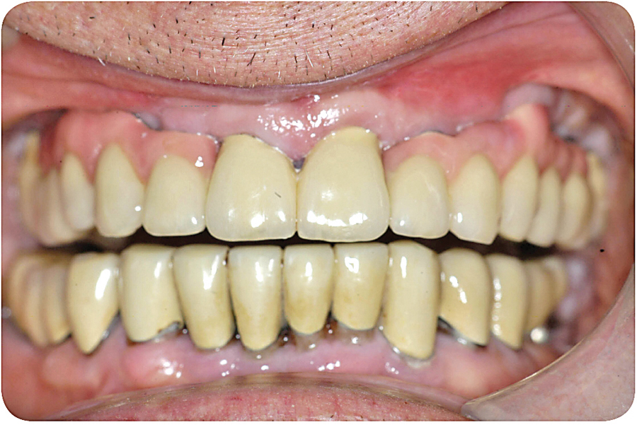 Figure 10. Finished Case Retracted.