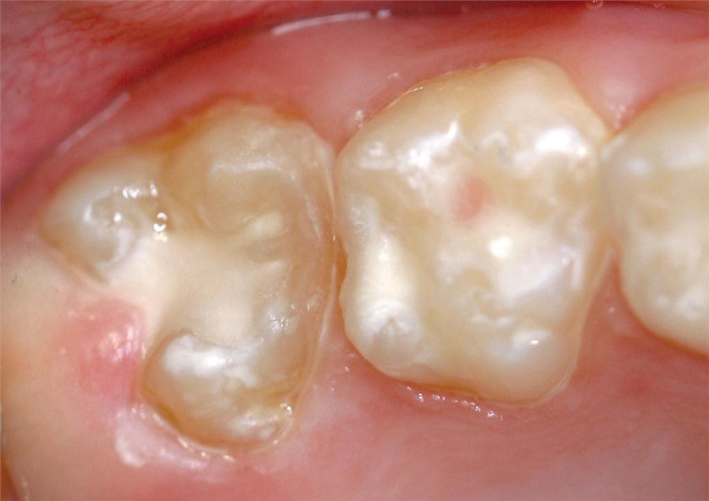 Figure 4B. Molar after sealing with glass ionomer plus the deciduous second molar. Note: glass ionomer has been flowed under the operculum.