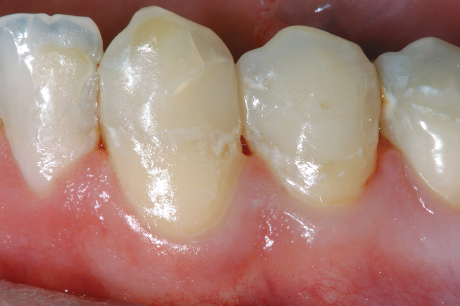 Figure 9. Mandibular canine and first premolar restored with nano-hybrid composite resin (N'Durance).