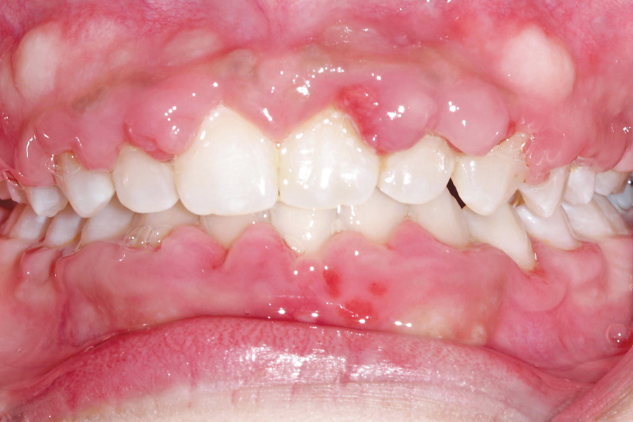 Figure B. After orthodontic treatment. Note hyperplasia of gingival secondary to anti-seizure medication