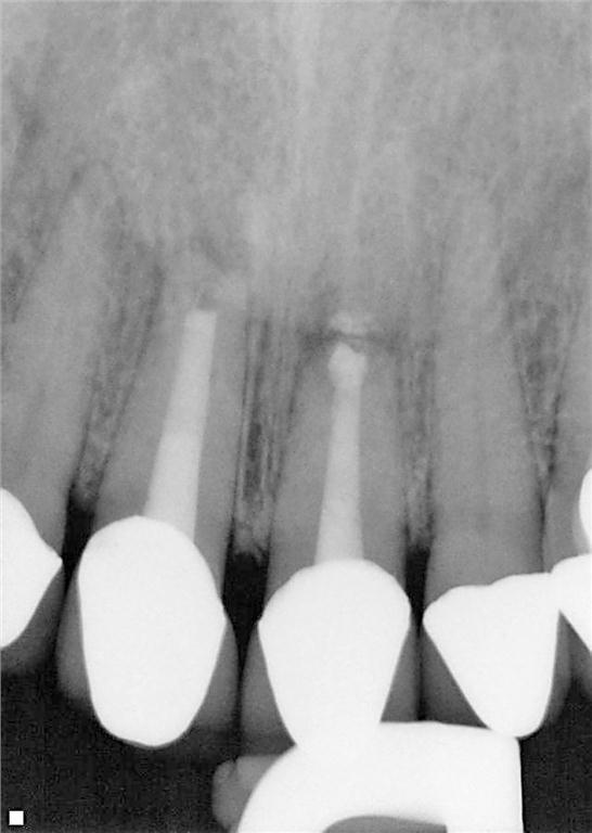 Figure 13. 3-month recall radiograph.