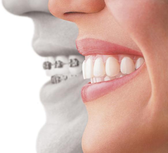 Ease of use has many more Dentists performing cosmetic orthodontic treatments.