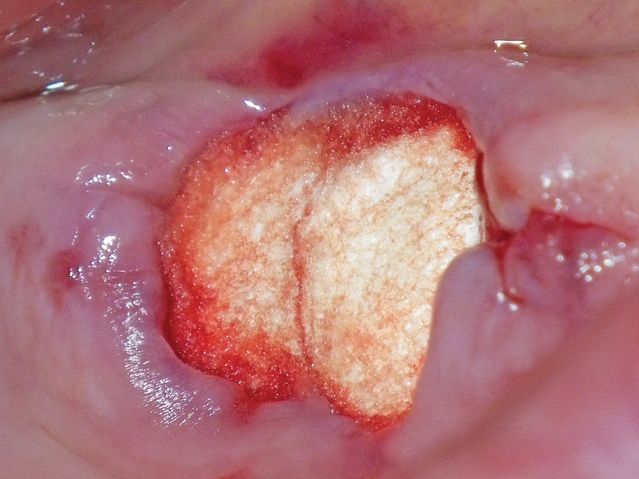 Figure 12. Based on the anatomic configuration of the intact extraction socket and due to financial constraints, conventional ridge preservation was not affordable at the time of extraction. Stabilization of the blood clot and biocompatible wound coverage was achieved by placing condensed gelfoam into each of the root sockets and the width of the extraction socket, and held in place with resorbable sutures (not depicted).