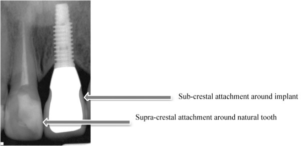 Implant Staging for Ideal Esthetics - Oral Health Group
