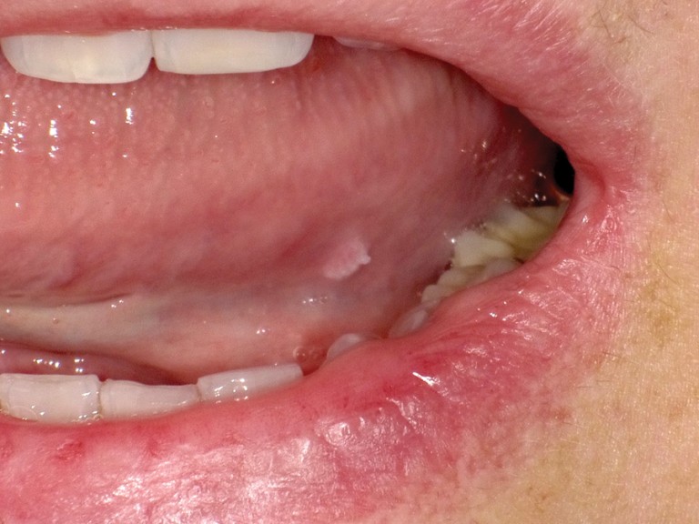 Seeing the Unseen Oral Cancer Risk Assessment Past Present and Future