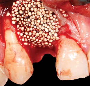 FIGURE 9D. Placement of GUIDOR easy-graft CRYSTAL. In-situ hardening provides good stabilization.