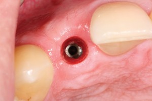 FIGURE 9J. Incisal view seven weeks after reopening the flap.