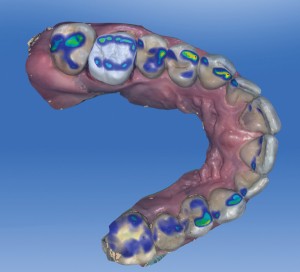 Initial Proposal of the Restoration with a Colour Map of the Occlusal Contact Points on the Full Arch