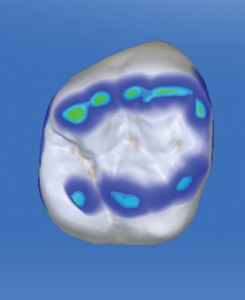 Colour Map of the Occlusal Contact Points