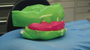 FIGURE 11. Centric relations record with bite registration material to record interocclusal positions and vertical dimension of occlusion.