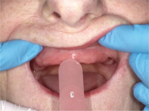 FIGURE 12. Pink acrylic shade selection to match the patient’s existing soft tissue edentulous ridges.